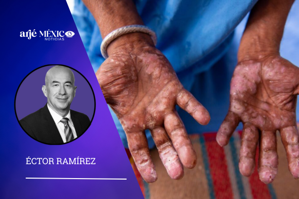 "La lepra es curable, el verdadero desafío es el estigma"