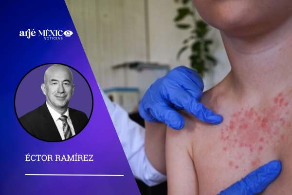 Durante años, advertir del riesgo del sarampión sonaba para muchos a exageración